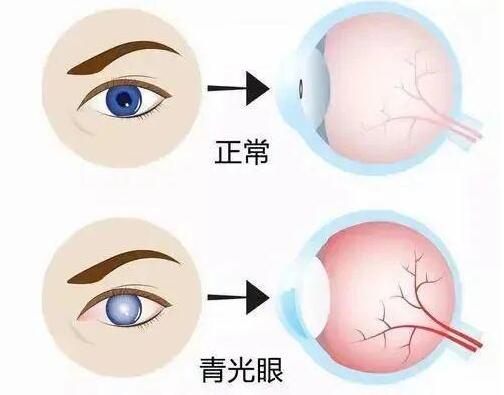 关灯后玩手机会得青光眼?权威说法来了!(图3) 关灯后玩手机会得青光眼?权威说法来了!(图3)