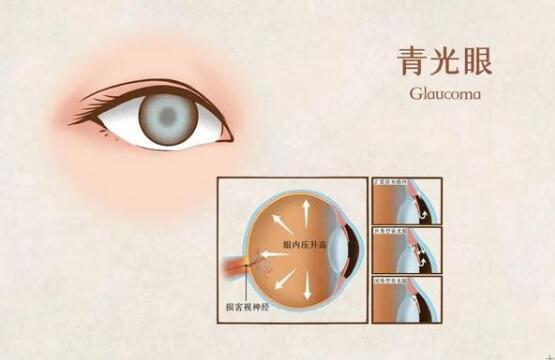 关灯后玩手机会得青光眼?权威说法来了!