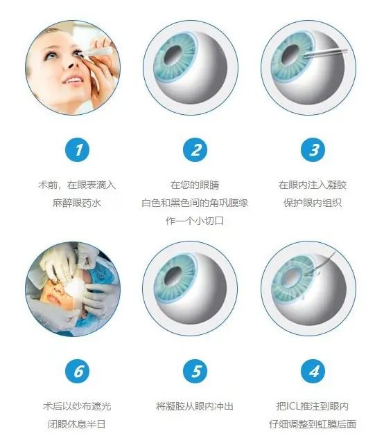 昆明普瑞眼科：眼科新技术研讨会——精细化ICL(图3)