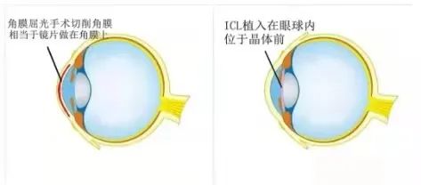 昆明普瑞眼科：眼科新技术研讨会——精细化ICL(图2)