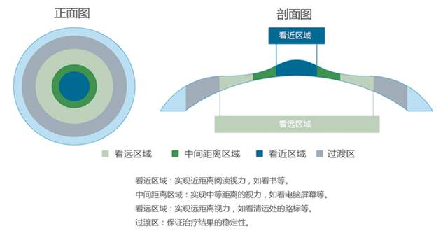 院长“尝鲜”,不用戴花镜,老花眼也可以矫正了(图3) 院长“尝鲜”,不用戴花镜,老花眼也可以矫正了(图3)
